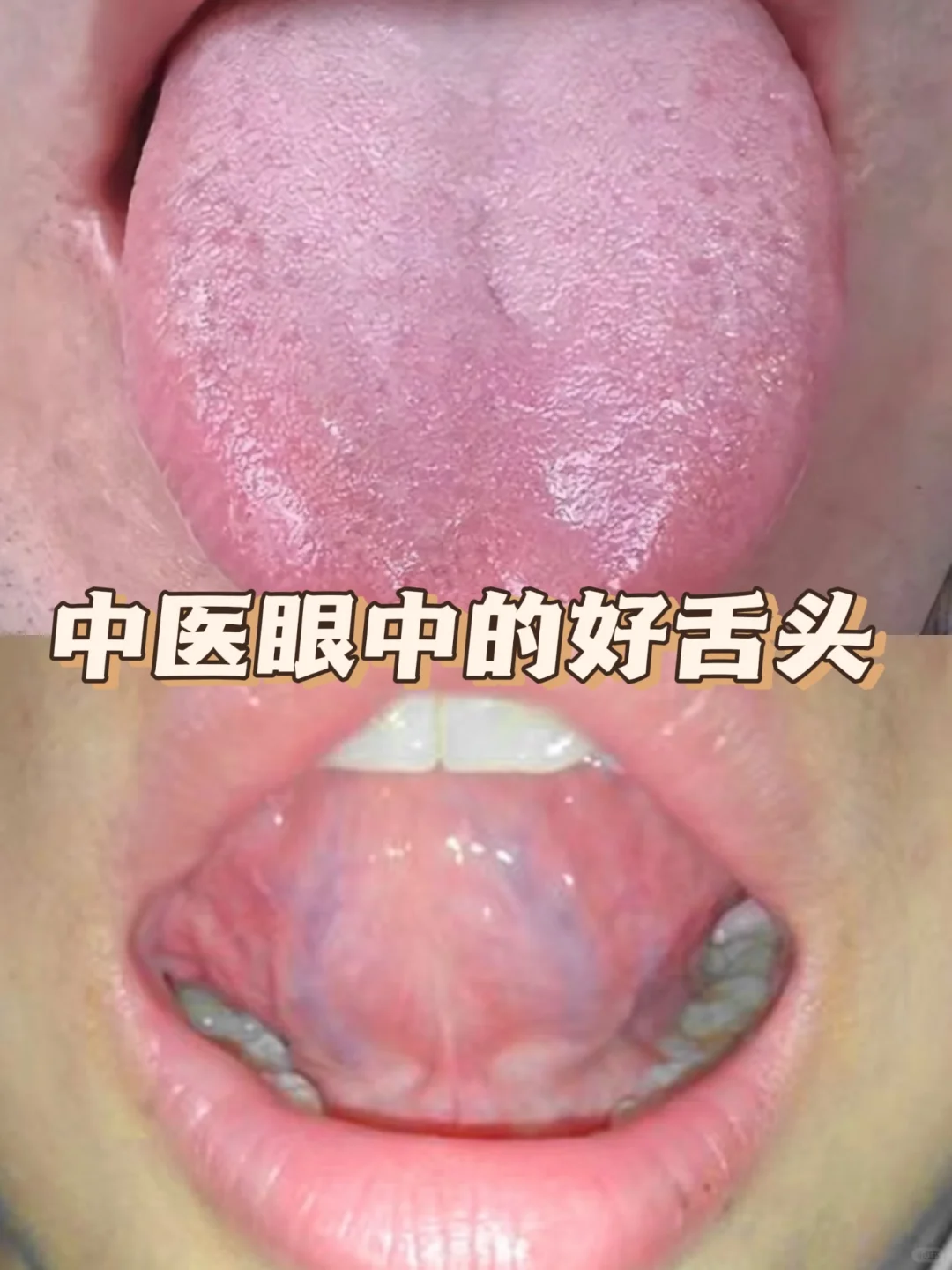 中医眼中健康的舌头👅