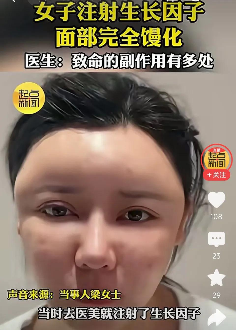 禁用!医美需慎重!湖北一女子脸部注射生长因子，过度医美，面部馒化酷似面具人！
网
