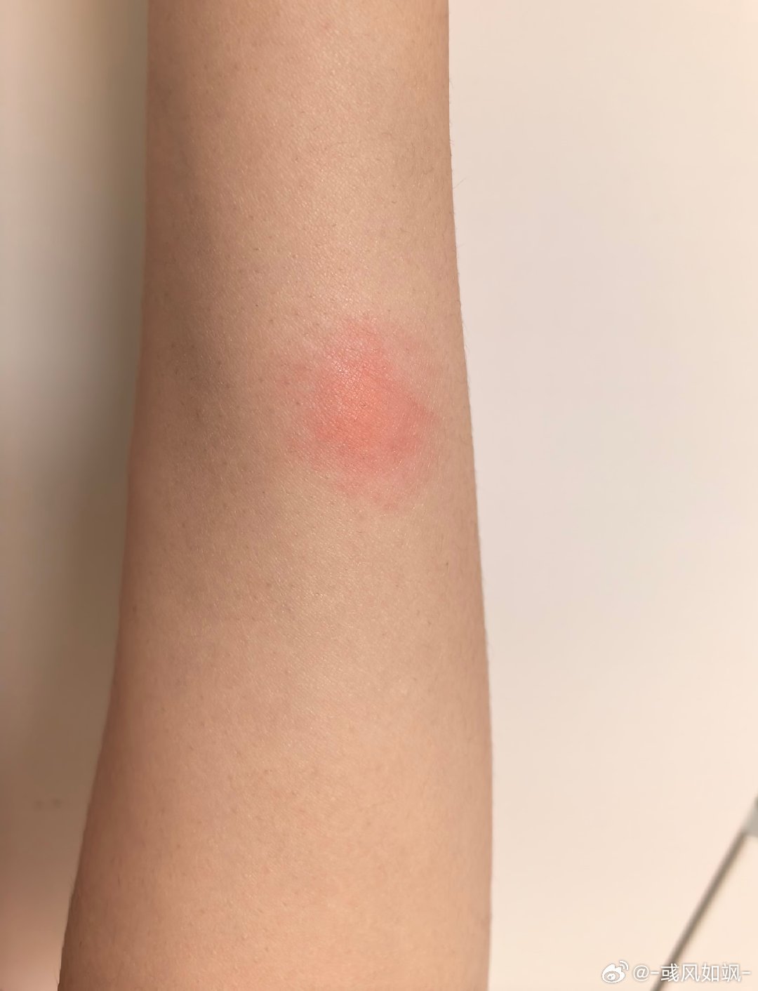 今年夏天第一个蚊子包 
