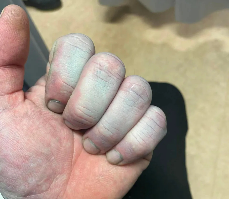 英国男子皮肤发蓝送医院急救据《太阳报》报道，英国男子 Tommy Lynch 早