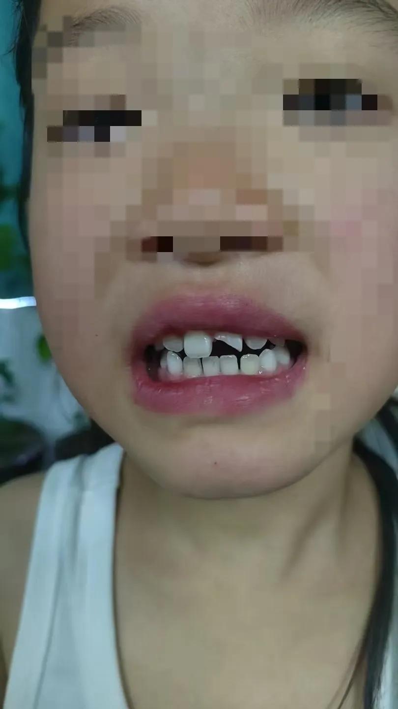 真的是怕啥来啥？
大家帮我看看，女儿的这个门牙摔成了两半，不知道是现在去补，还是