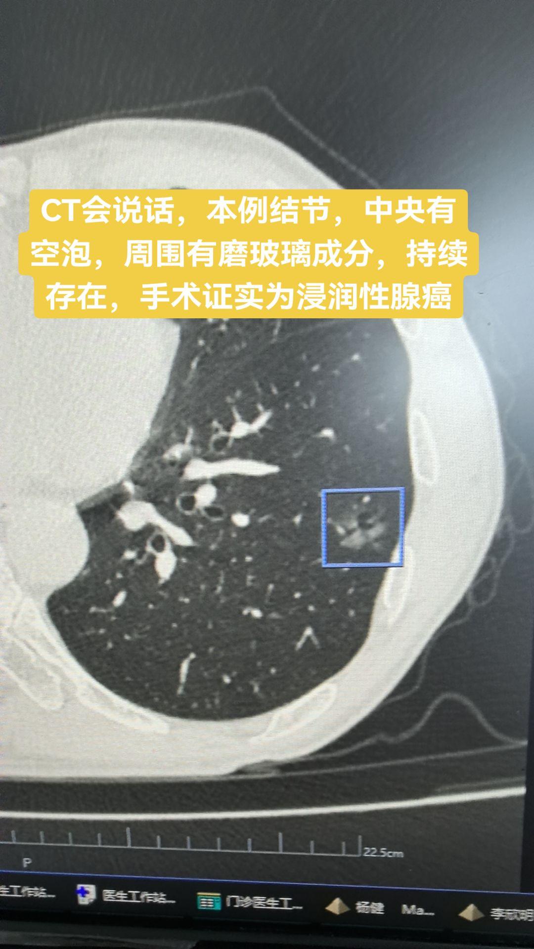 经典病例分享。CT会说话，本例结节，中央有空泡，周围有磨玻璃成分，持续...