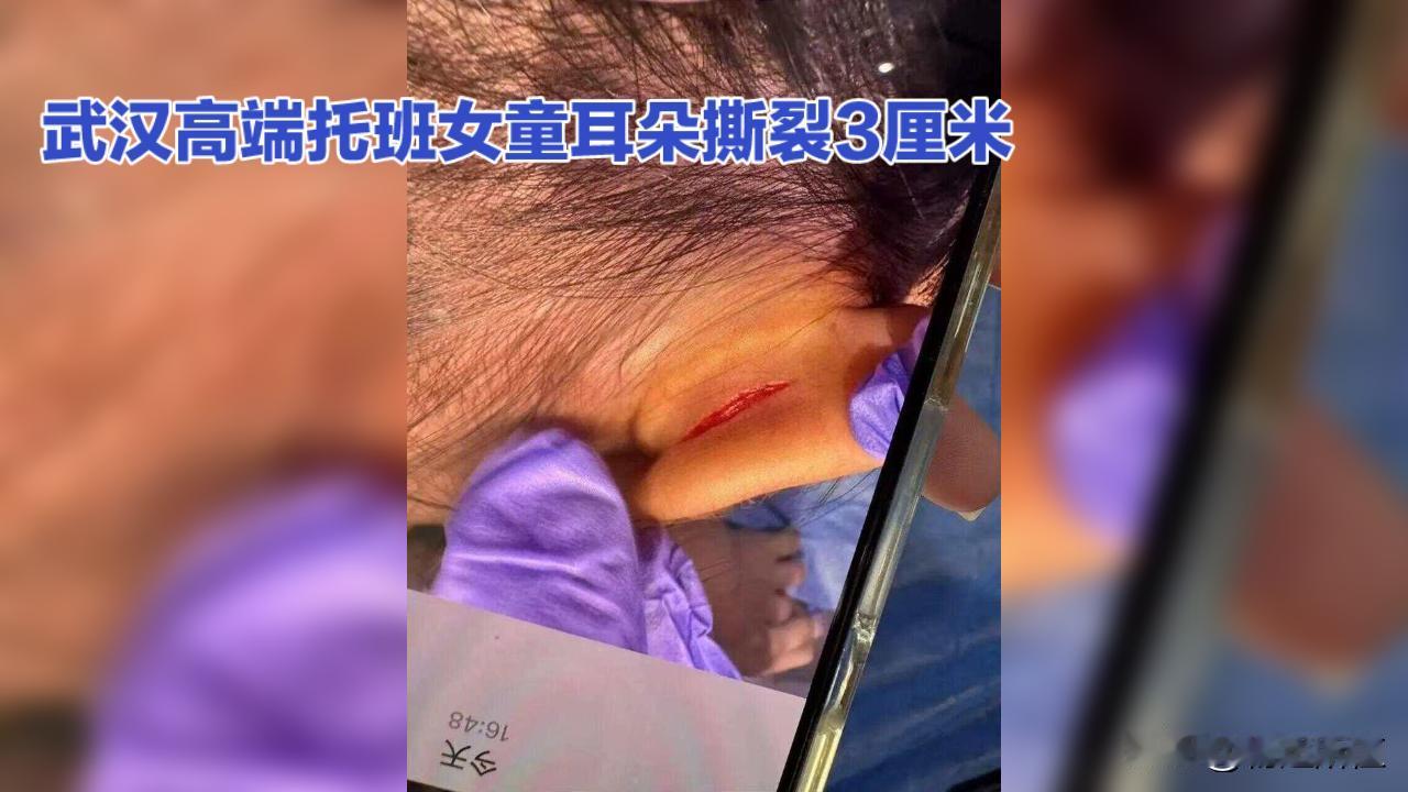 武汉高端托班女童耳朵撕裂3厘米 家长质疑监控“恰巧”失灵
 
武汉一家年花费超1
