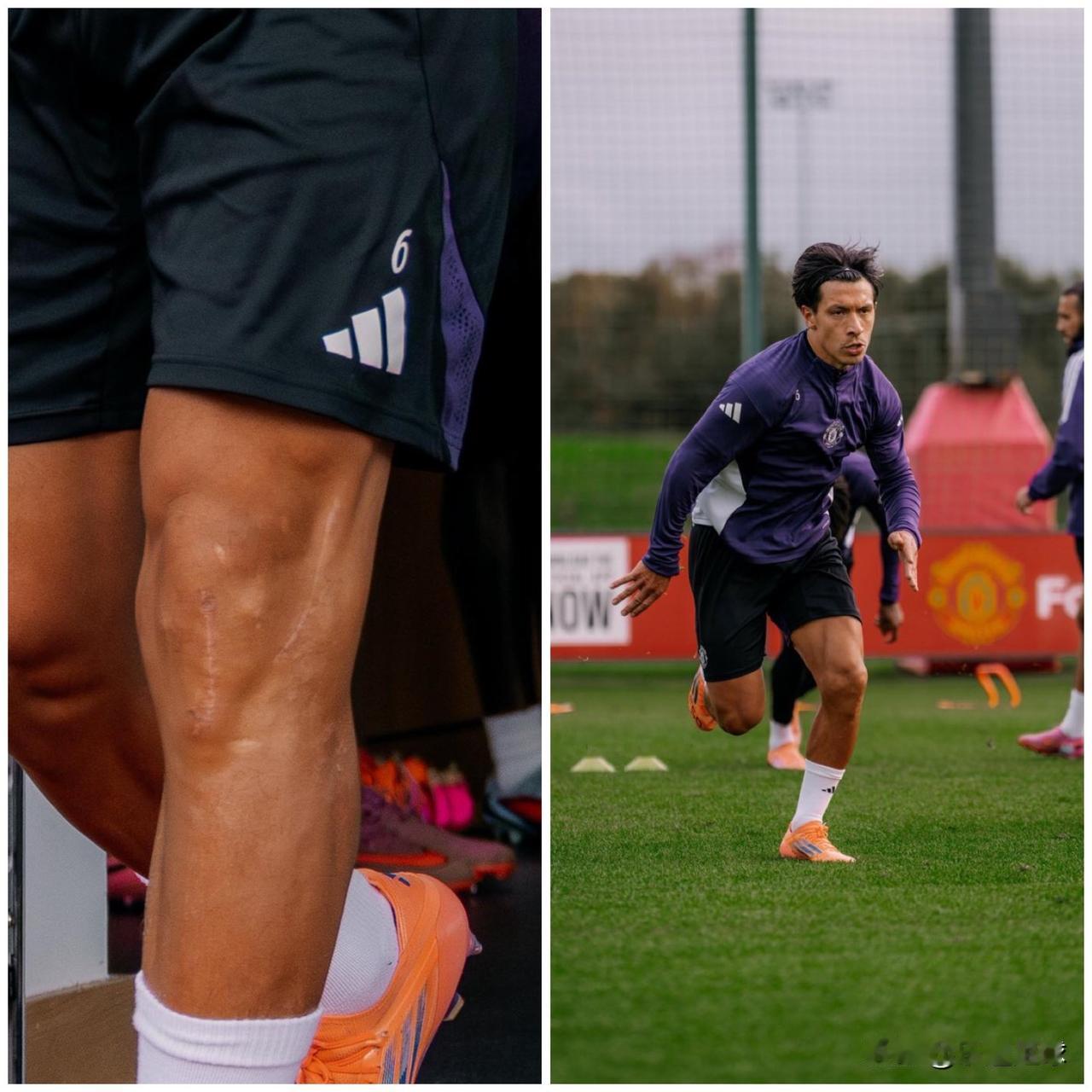 经过292个漫长而煎熬的日子，利桑德罗·马丁内斯终于归来。

你甚至能从他的膝盖