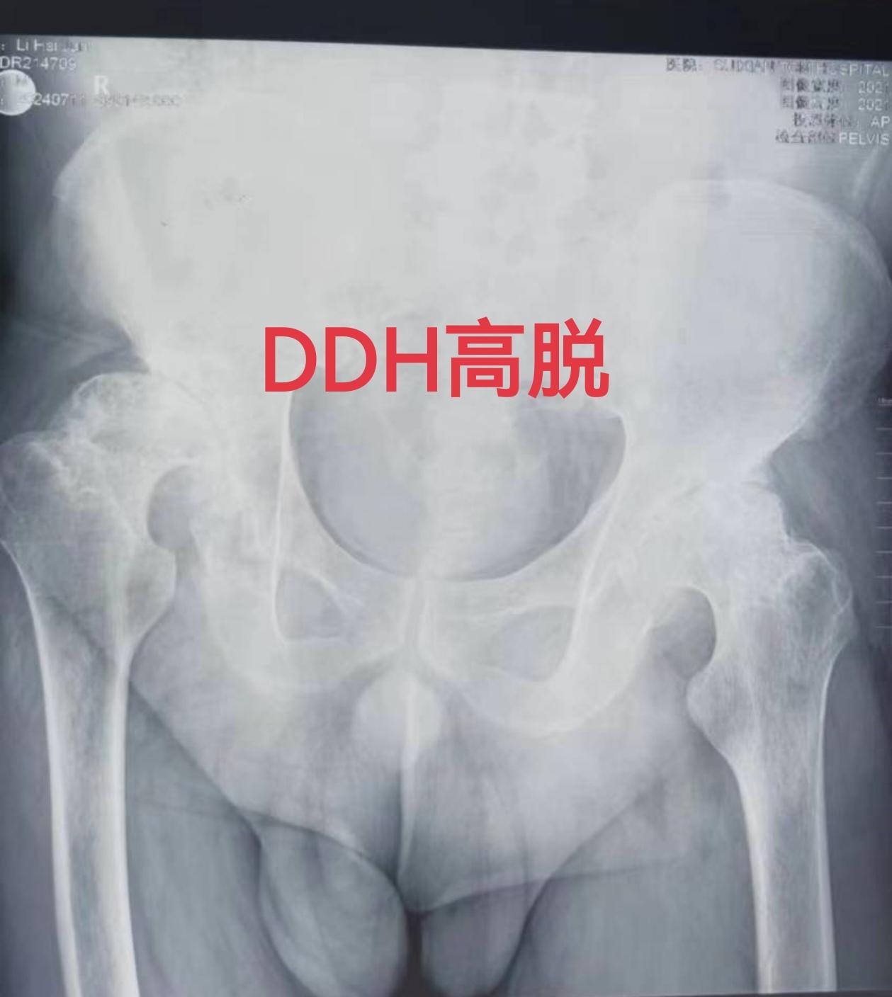 DDH髋关节置换。DDH高脱，术前短4cm，术后下肢等长，二期行对侧置...