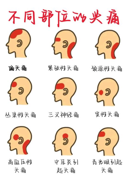 医学生笔记——不同部位头痛