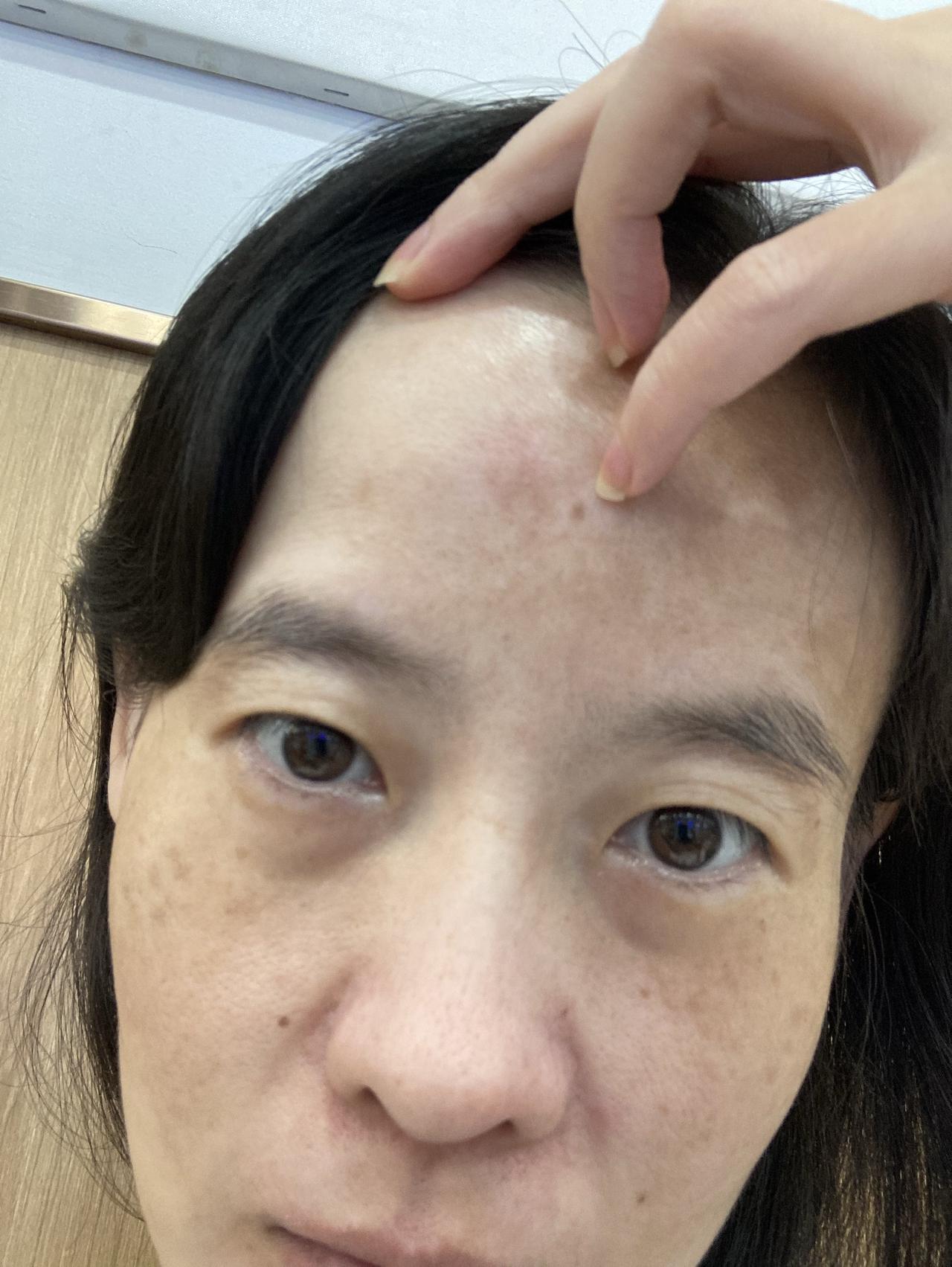好可怕，每天脸上和头皮痒爬爬的，其实我经常身上也像有蚂蚁咬那种，我应该是皮肤菌群