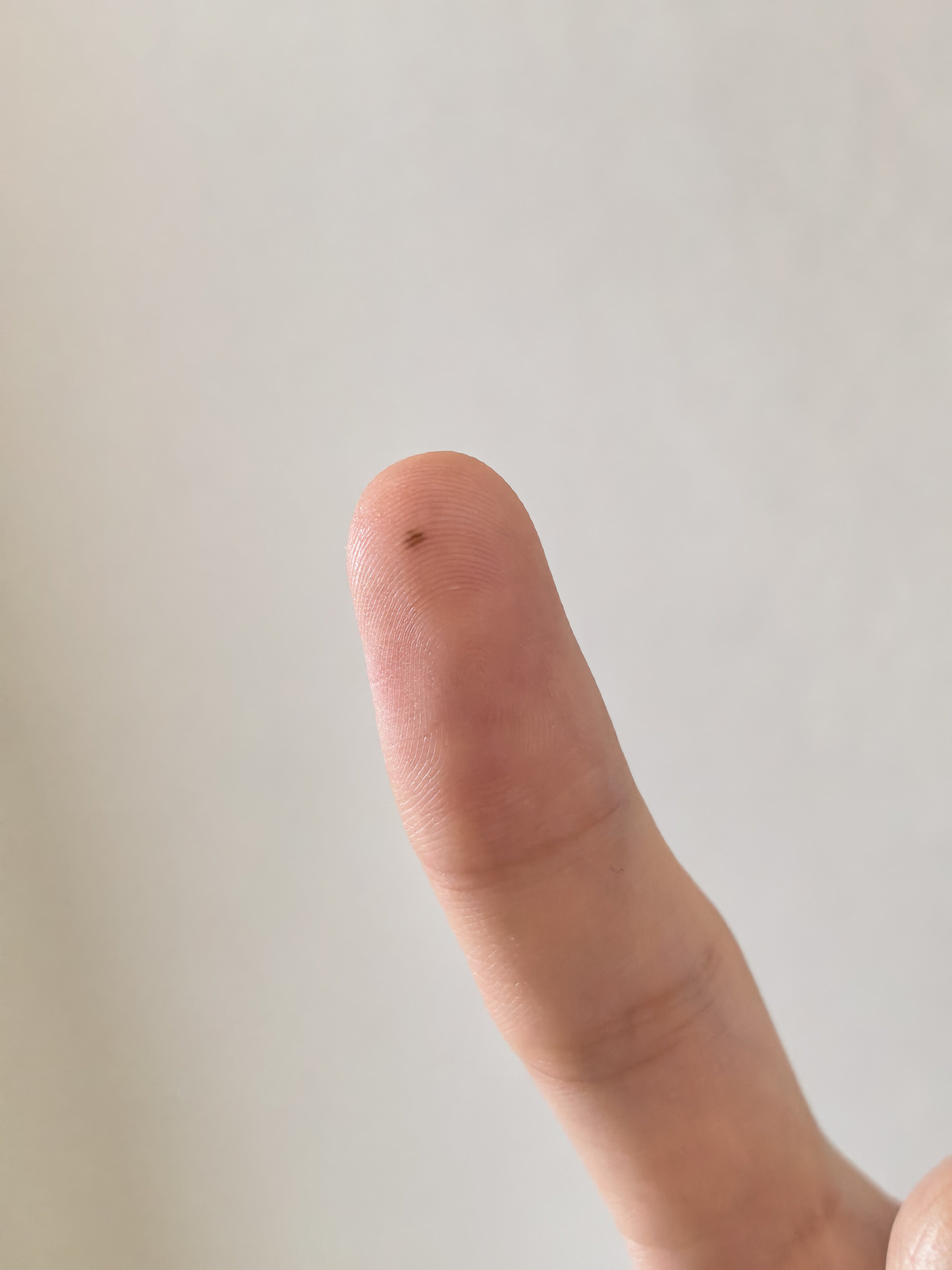 我记得这个痣小时候就有，这玩意为啥危险啊？ 