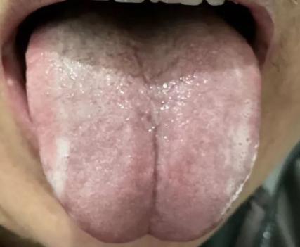 这个舌象，首先舌向患者同身侧右边偏一些。而且舌下脉络比较粗糙，年龄大的人首先要考