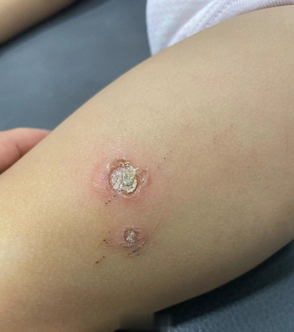 幼儿湿毒发疮女22个月，蚊子咬了，抓痒起泡流水，半月未愈，时时有低烧37.5。十