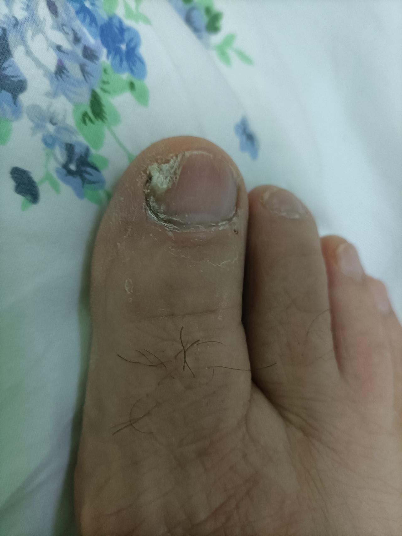 我的灰指甲，抹完第四盒这个药，就要考虑换药了！
从去年11月份抹这个药，感觉灰指