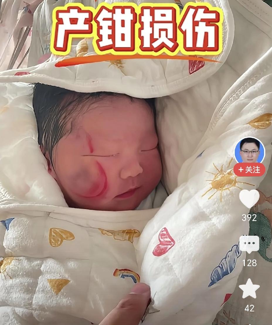 产钳损伤，据说一个月后就可以自愈，大家了解这个吗？