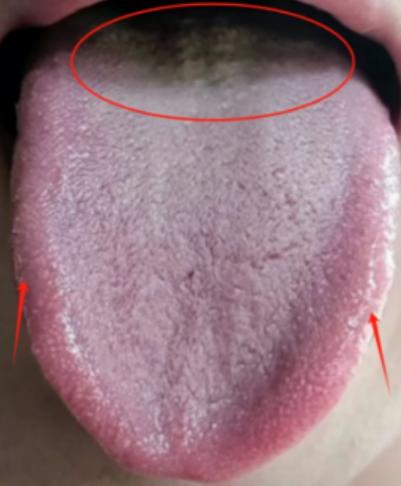 这种舌头简直没法看，从头到脚哪哪都是病

患者平时畏寒肢冷，手脚冰凉，经常少气懒