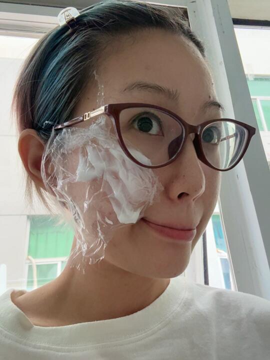 疤痕打第2️⃣次点阵了！分享一下激光祛疤过程