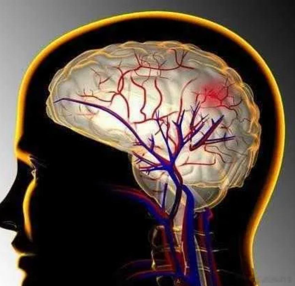 脑血栓多是“拖”出来的，提醒：头部有4种“异常”，赶快查脑CT1、头痛：头痛是脑