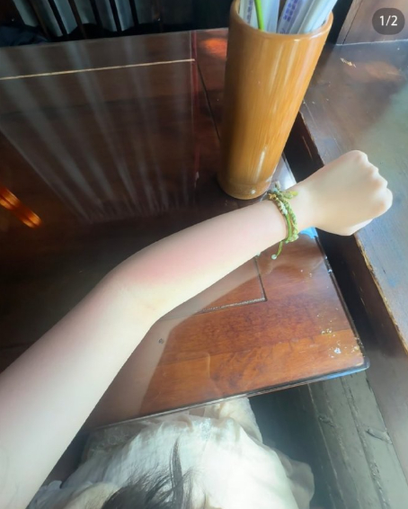 被夏天的紫外线背刺了 夏天的太阳很有欺骗性，不冷不热的，就想出去玩，不知不觉就黑