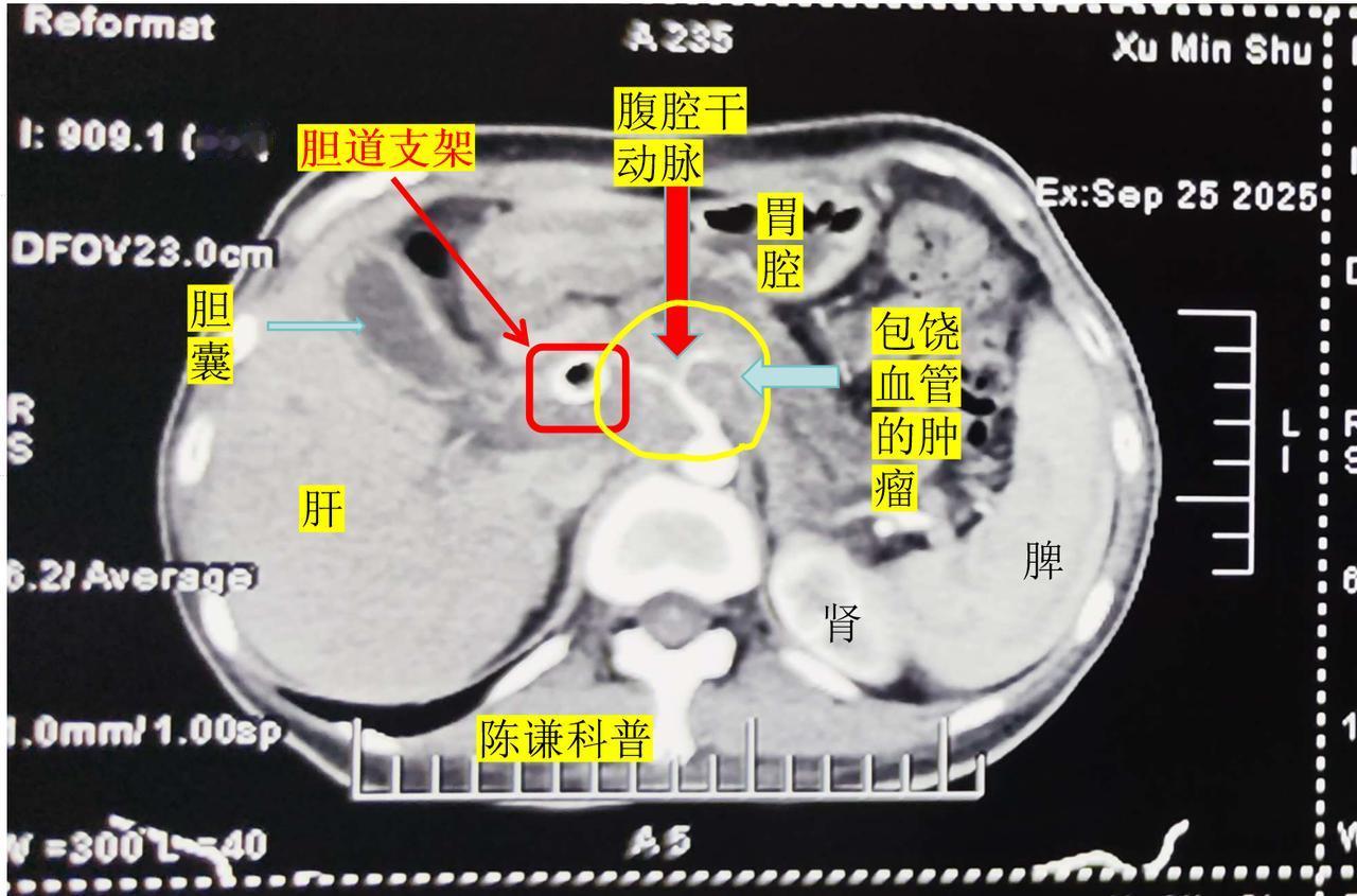 胰腺癌晚期患者如何缓解疼痛?
胰头癌是胰腺癌中最常见的类型，由于肿瘤很容易侵犯胆