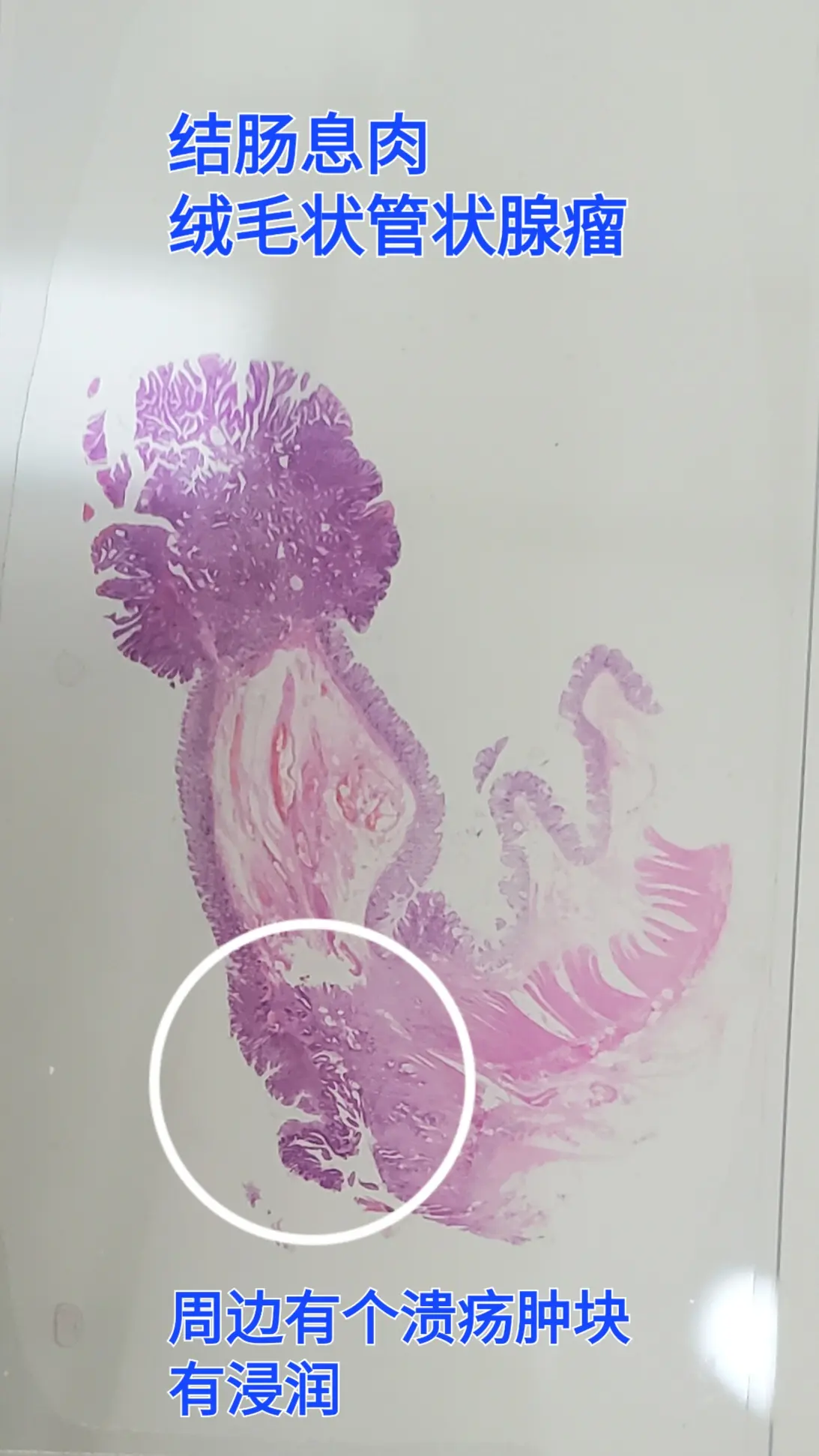 结肠癌 结肠息肉 管状绒毛状腺瘤