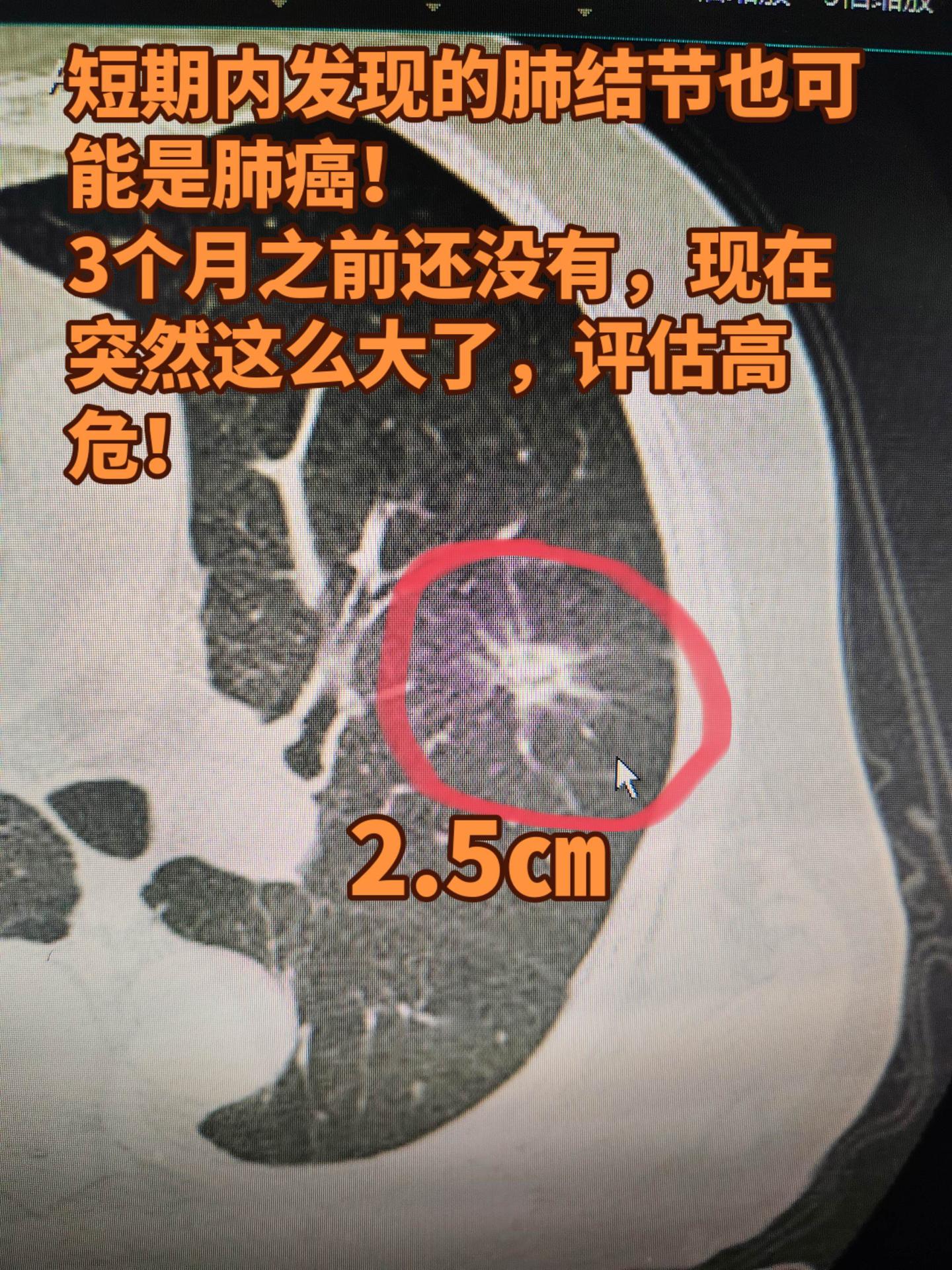 短期发现的肺结节会是肺癌吗。三个月前检查还没有的 ，消炎半个月复查，肺...