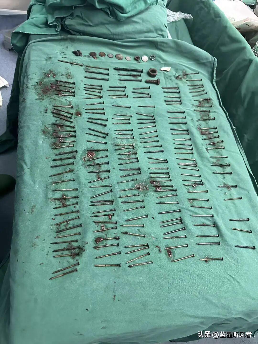 不可思议！完全不敢相信！男子胃里取出180颗铁钉，密密麻麻太吓人！
 
真的大开