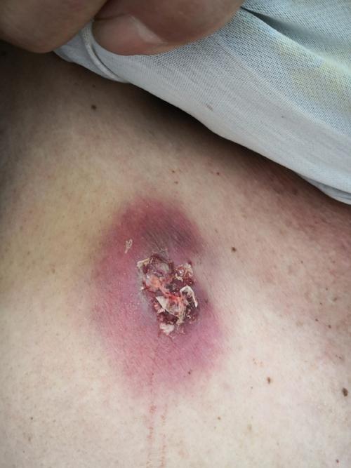 惊！女子没消毒帮人挤脓肿，竟致对方死亡！56.7万赔偿背后，这些常识你必须懂
 