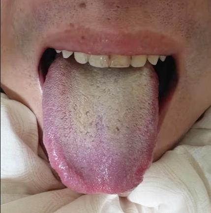 36岁小兄弟，真是无恶不作！身体一堆毛病
患者自述：一动就出汗多，爱生闷气，看啥