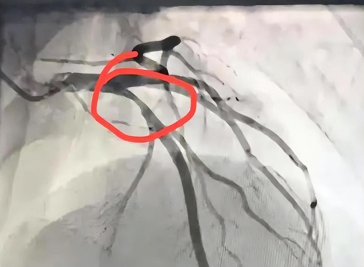 血管堵没堵，一个检查，既简单又便宜，通血管的最佳方法

血管这个东西，平时感觉不