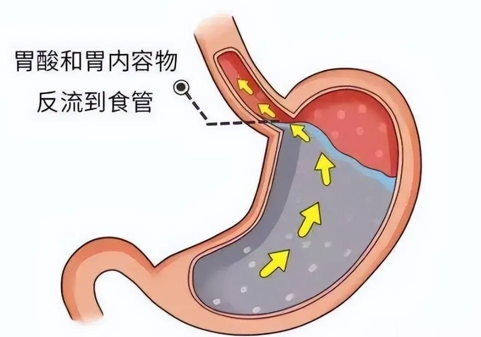 胃食管反流的朋友，做好这五点很关键。胃食管反流病总是反反复复，像感冒一样，治好了