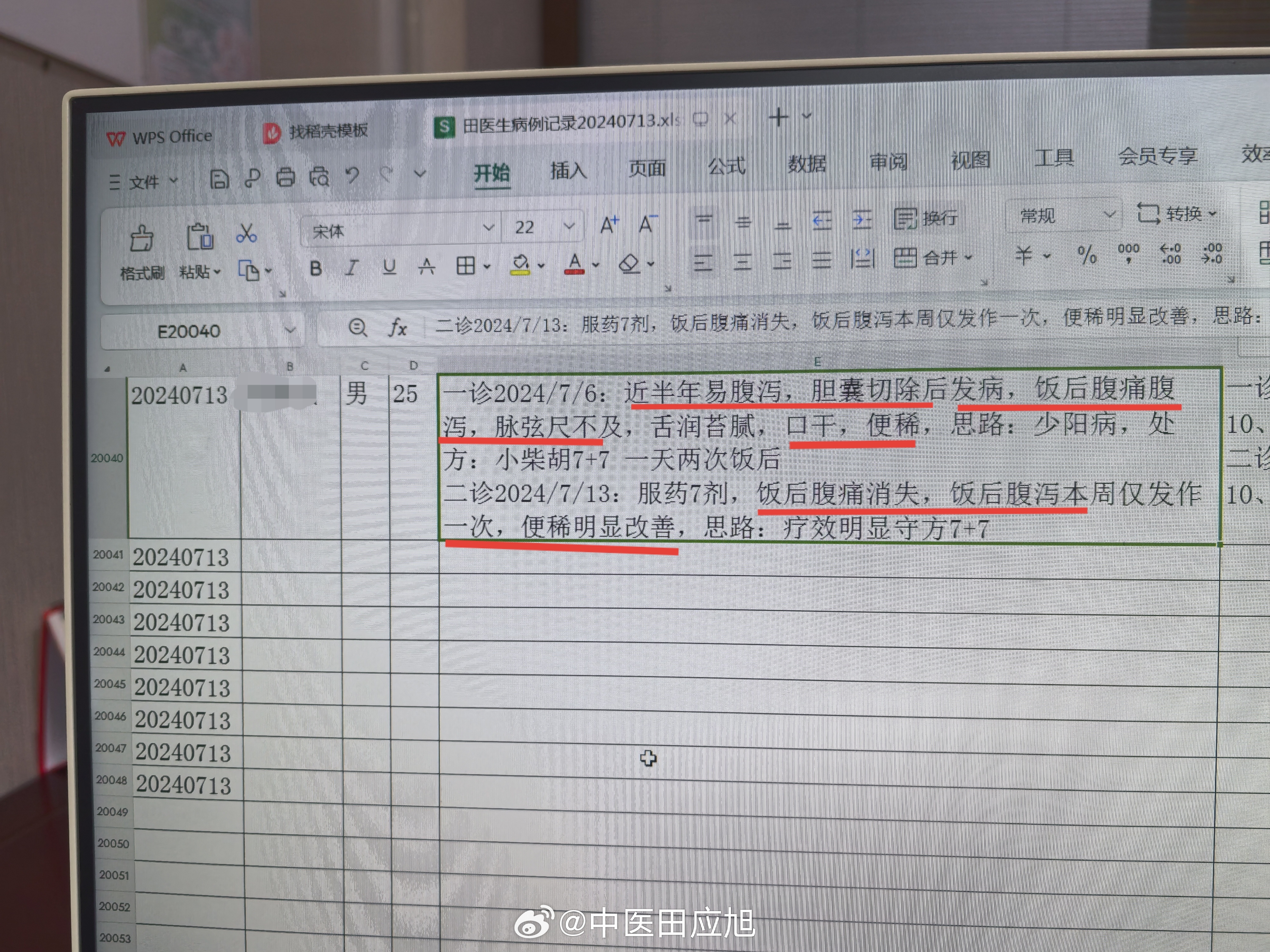 #中医#  25岁帅小伙，胆囊切除手术后发作腹痛、腹泻半年，每天吃饭后必发腹痛腹