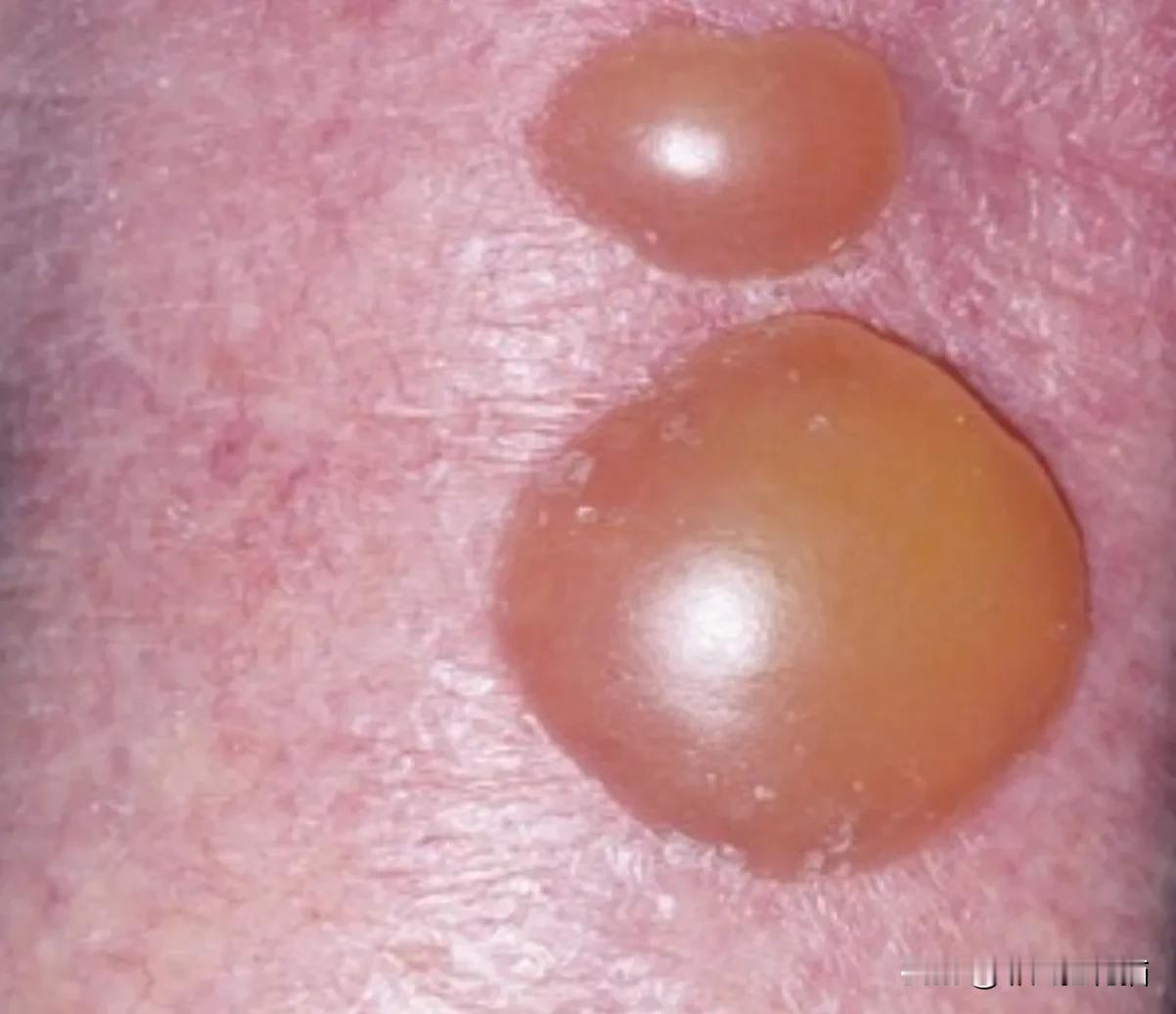 烫伤处理小知识｜老头买热敷腰带敷出大水泡，太糟心！
 
真没想到热敷腰带竟敷出祸