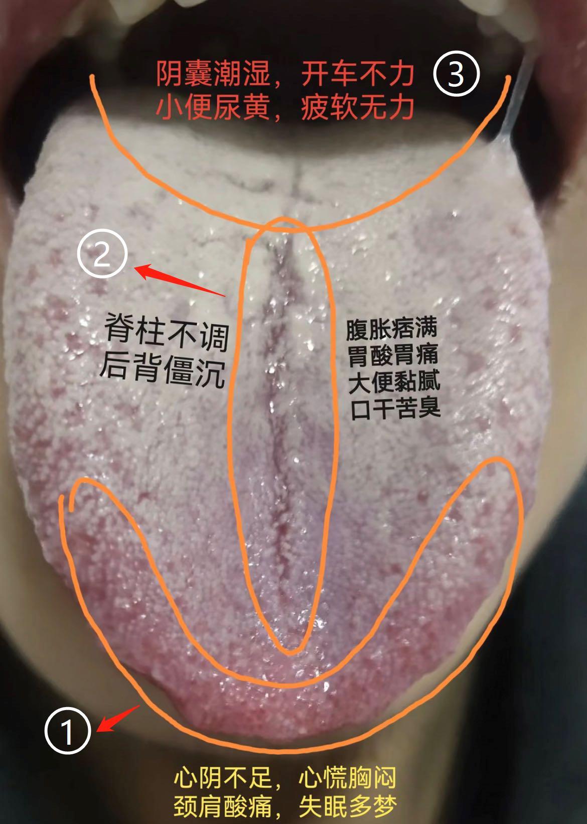 一位26岁男士，舌头上有一道长长的裂纹，而且阴囊潮湿，下焦湿热