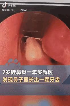 活久见！河南郑州，一7岁男孩因患鼻炎1年半，难受得不行，家长就带着他去医院。
