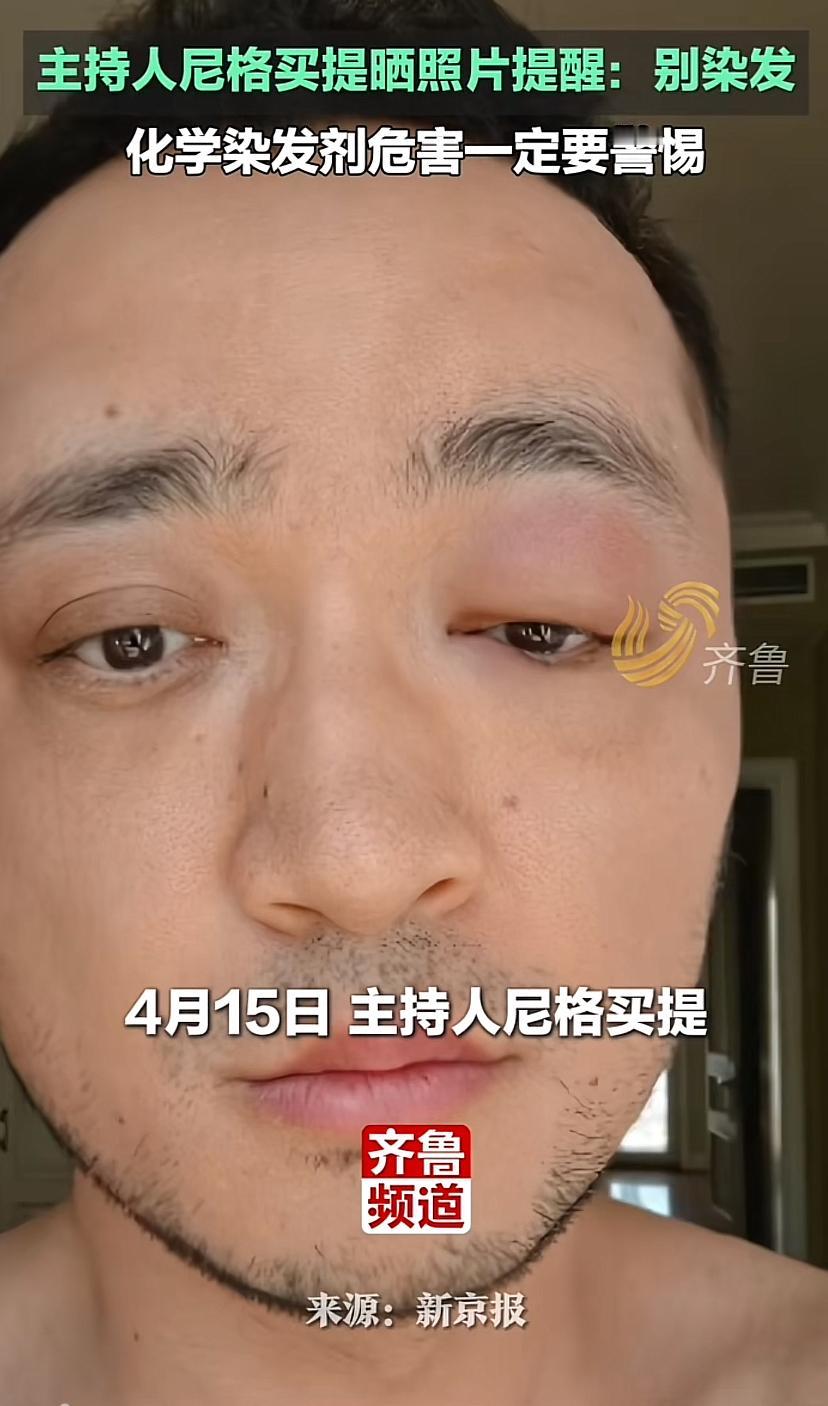 别染发，别染发，别染发！重要的事情说三遍。

看主持人尼格买提这眼皮肿得老高，还