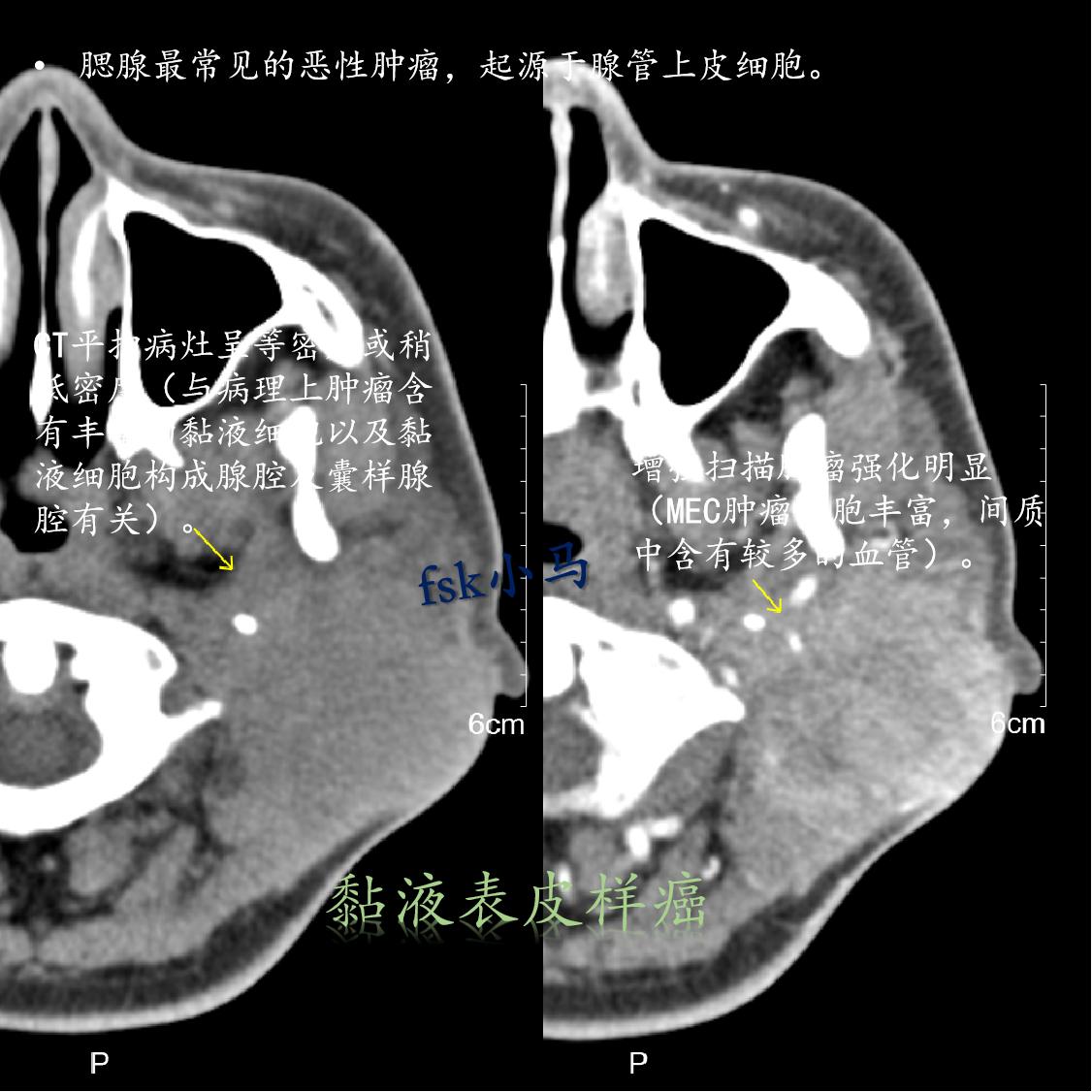 黏液表皮样癌(mucoepidermoid carcinoma，MEC...