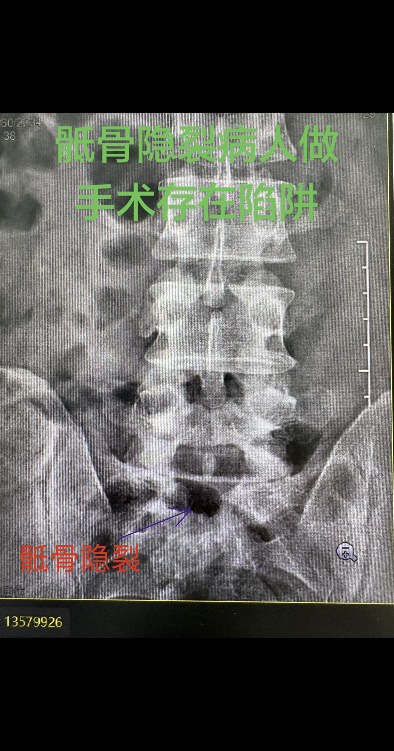 骶骨隐裂的患者手术注意了。    展示一例最近完成的腰椎手术病人X光片...