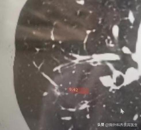 肺结节一旦考虑肿瘤，就要马上切了？很多朋友体检发现肺结节后，最纠结的就是