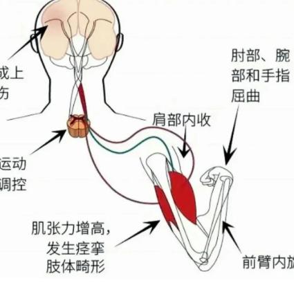 偏瘫后身体僵硬像石头？太多人深受张力异常困扰了

我在门诊经常遇到偏瘫患者和家属