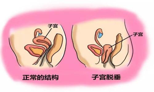 #健康真探社#【阴挺是什么病？主要原因是什么？】中医上将子宫脱垂称为阴挺，一般会