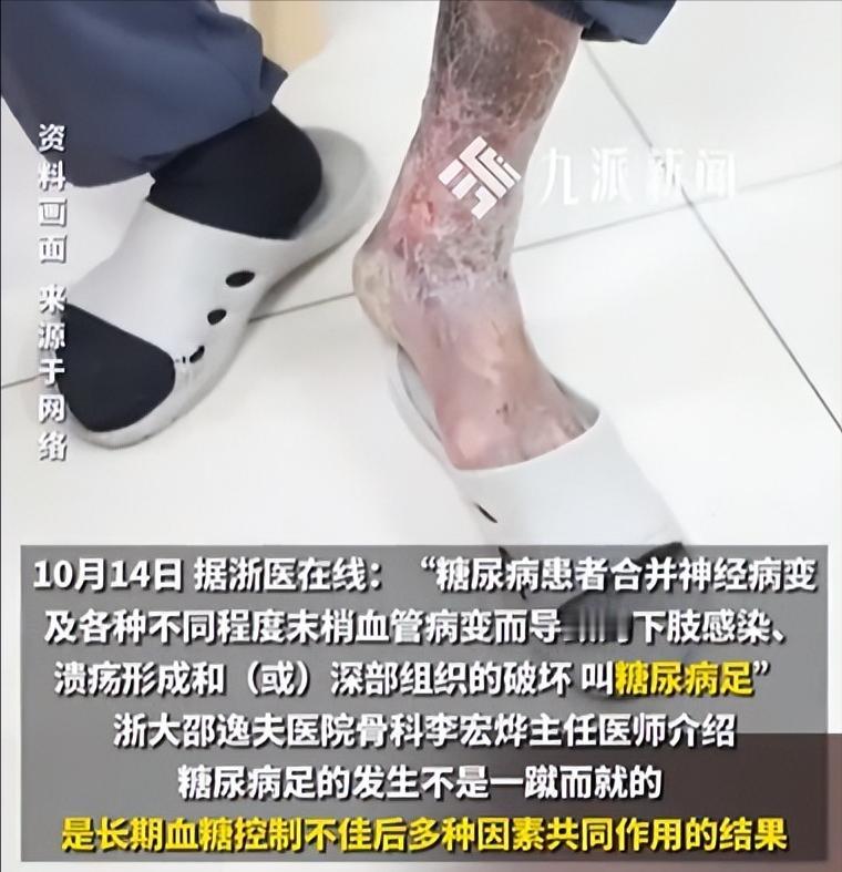 “可惜没有后悔药！”14日报道，浙江一男子剪脚指甲，不慎剪破拇趾边缘，出血并不多