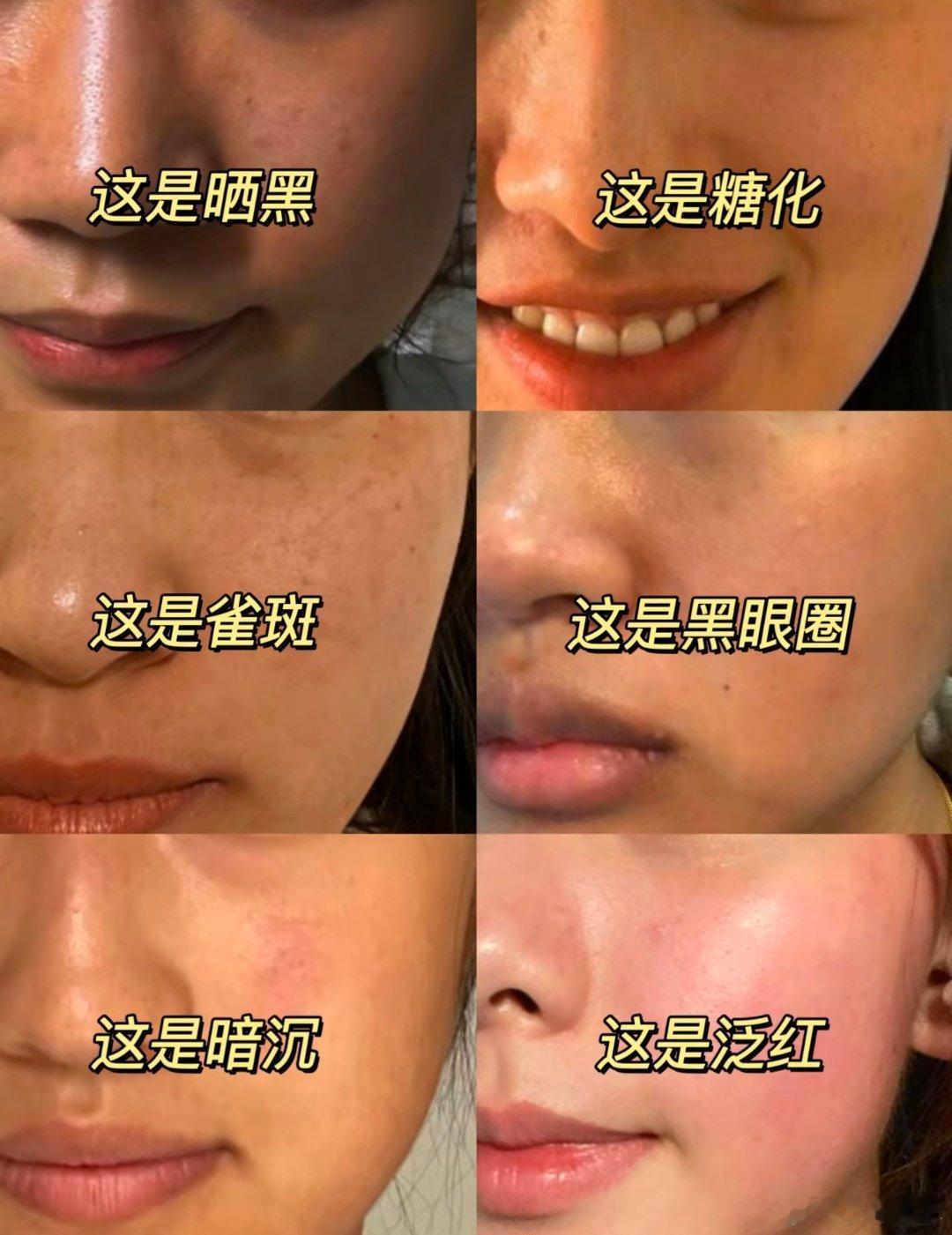 糖化脸和吃糖是什么关系看来还得控糖，吃多了的话，皮肤变得又黄又垮，还爱长痘[允悲