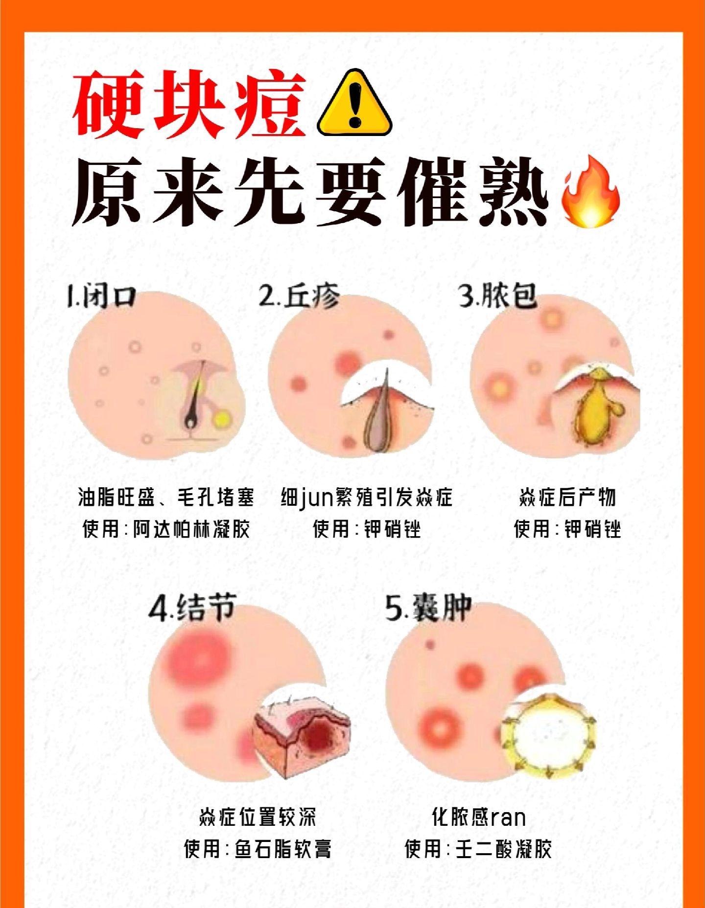 为什么痘痘会变硬?长痘不要挤先催熟。长痘痘怎么办如何拯救痘痘肌