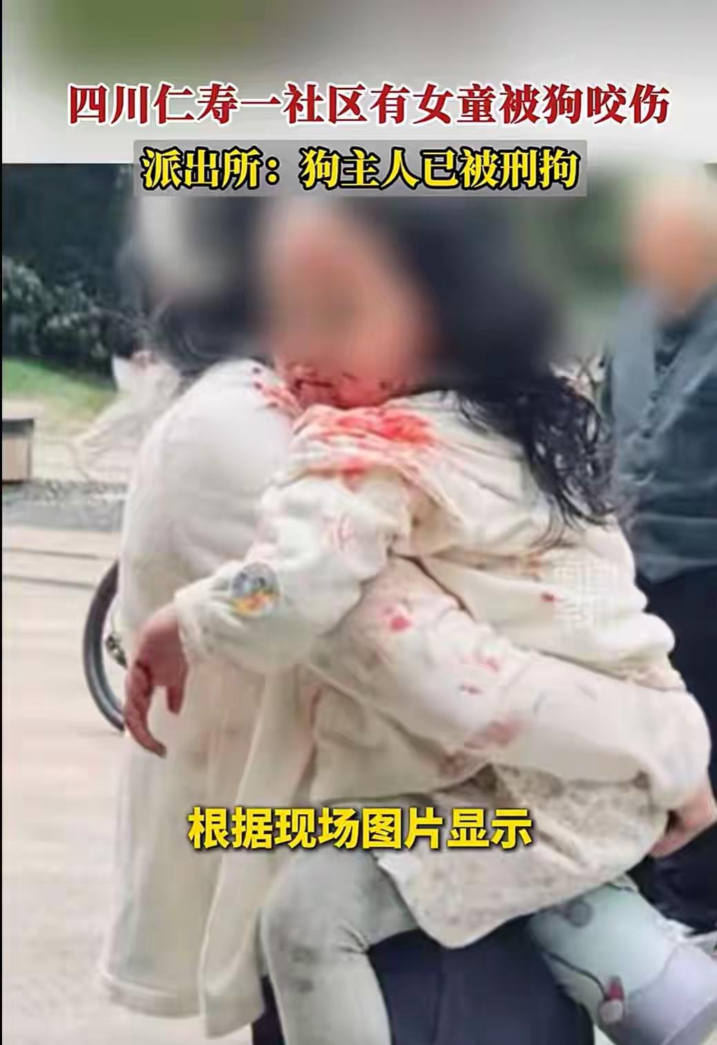 强烈建议从重处理四川眉山那个遛狗女，因为那个被咬伤最严重的小女孩可能会面临毁容，