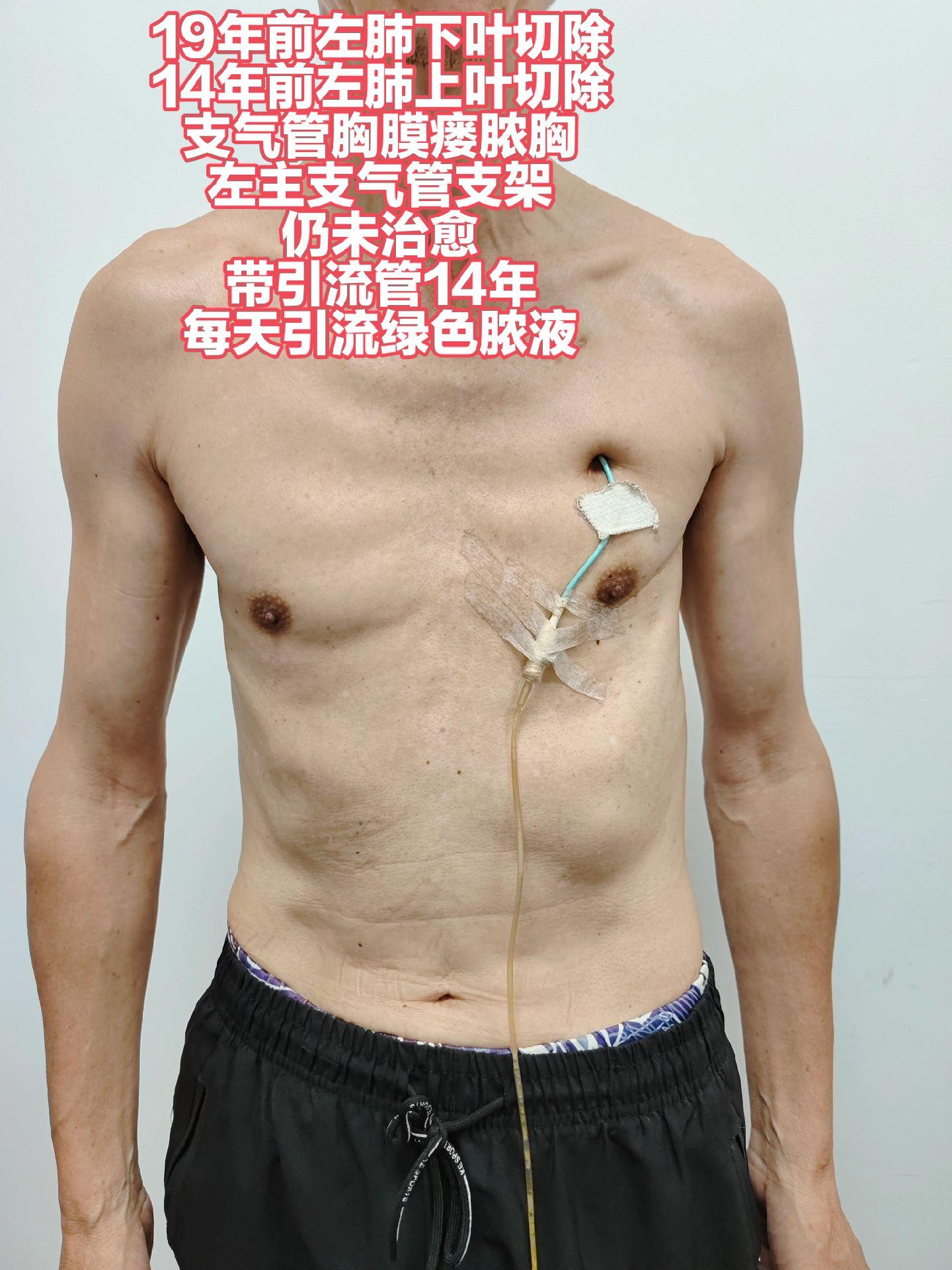 河南病友，家属说已经开过三次大刀了，体重只有90来斤。今日战至入夜，顺利修复。