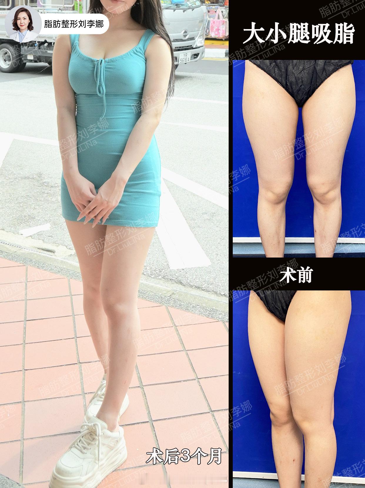 脂肪整形刘李娜大腿吸脂大腿抽脂 术前典型的大腿脂肪比较多，假胯宽，小腿后外侧脂肪