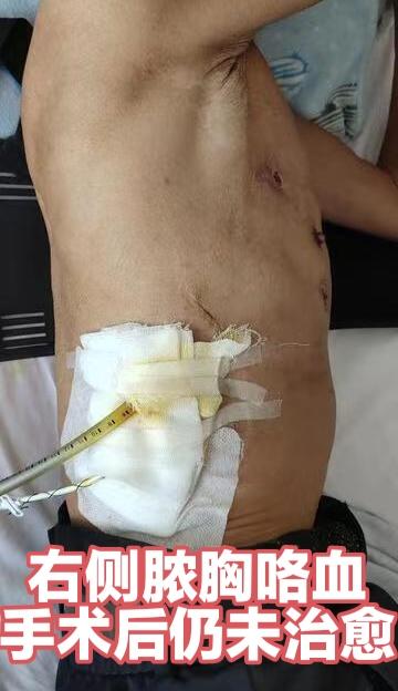 东北病友右侧支气管胸膜瘘脓胸微创治愈。东北病友，儿子是外科同行，右侧脓胸清创术后仍有巨大脓腔。昨日二期修复，最小创伤完成，几无出血，无肌肉损伤，外观功能完全正常，一次治愈。