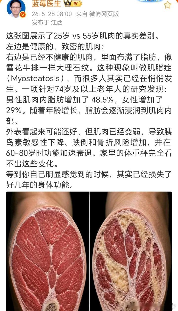 一项针对74岁及以上老年人的研究发现：男性肌肉内脂肪增加了 48.5%，女性增加