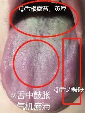舌边鼓胀情绪差，肝郁脾虚湿盛，调理需疏肝健脾祛湿

①舌根部位舌苔黄厚，干燥程度