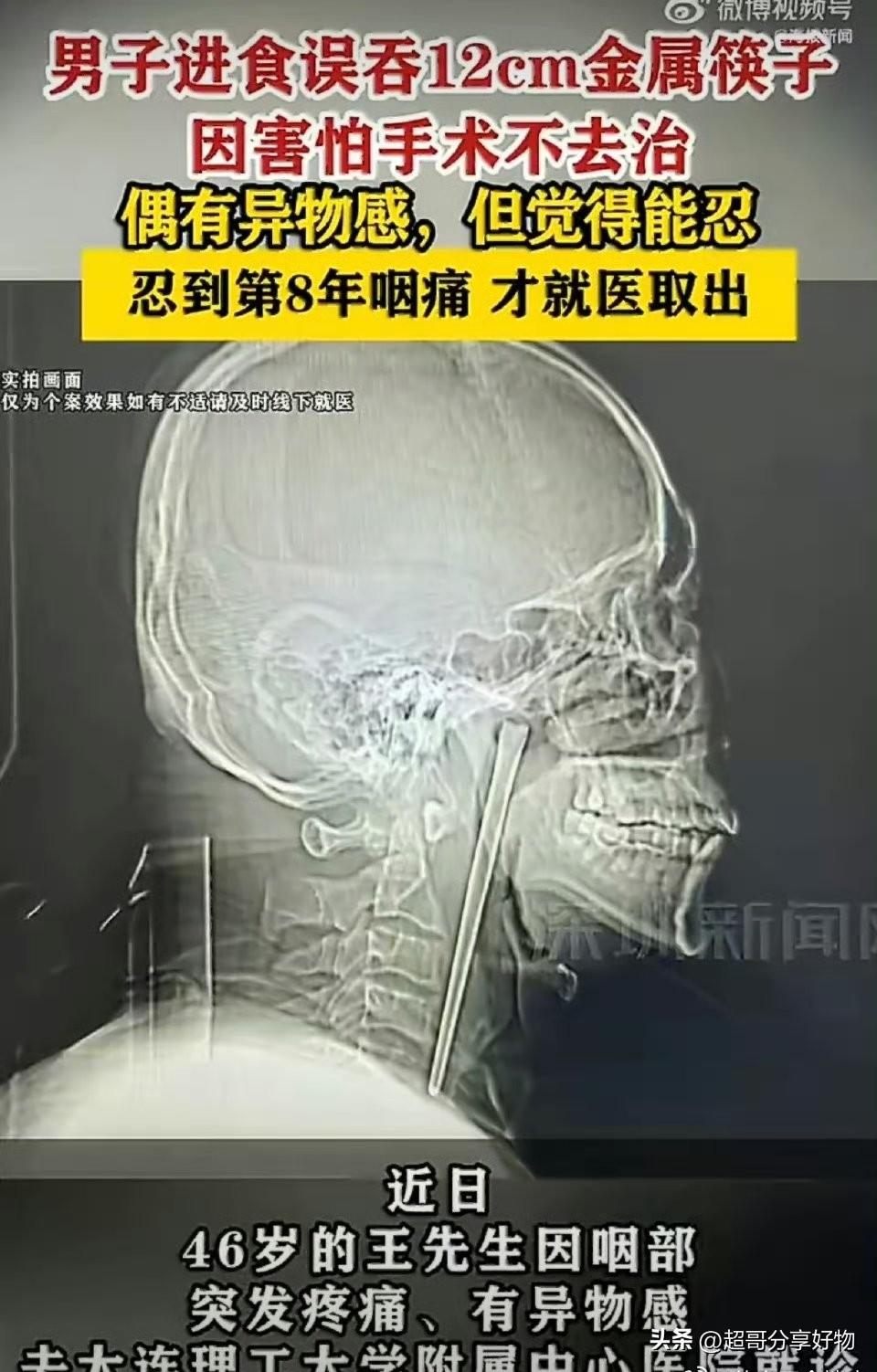男子误吞12厘米筷子忍8年才取出：侥幸背后是拿命硬扛
 
12厘米金属筷子在咽部