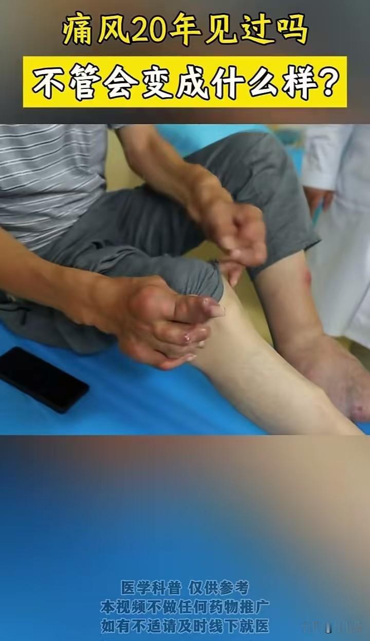 实在让人无比震惊！痛风放任不管二十年，双手双脚已经被痛风石严重侵蚀变形。脚趾肿大