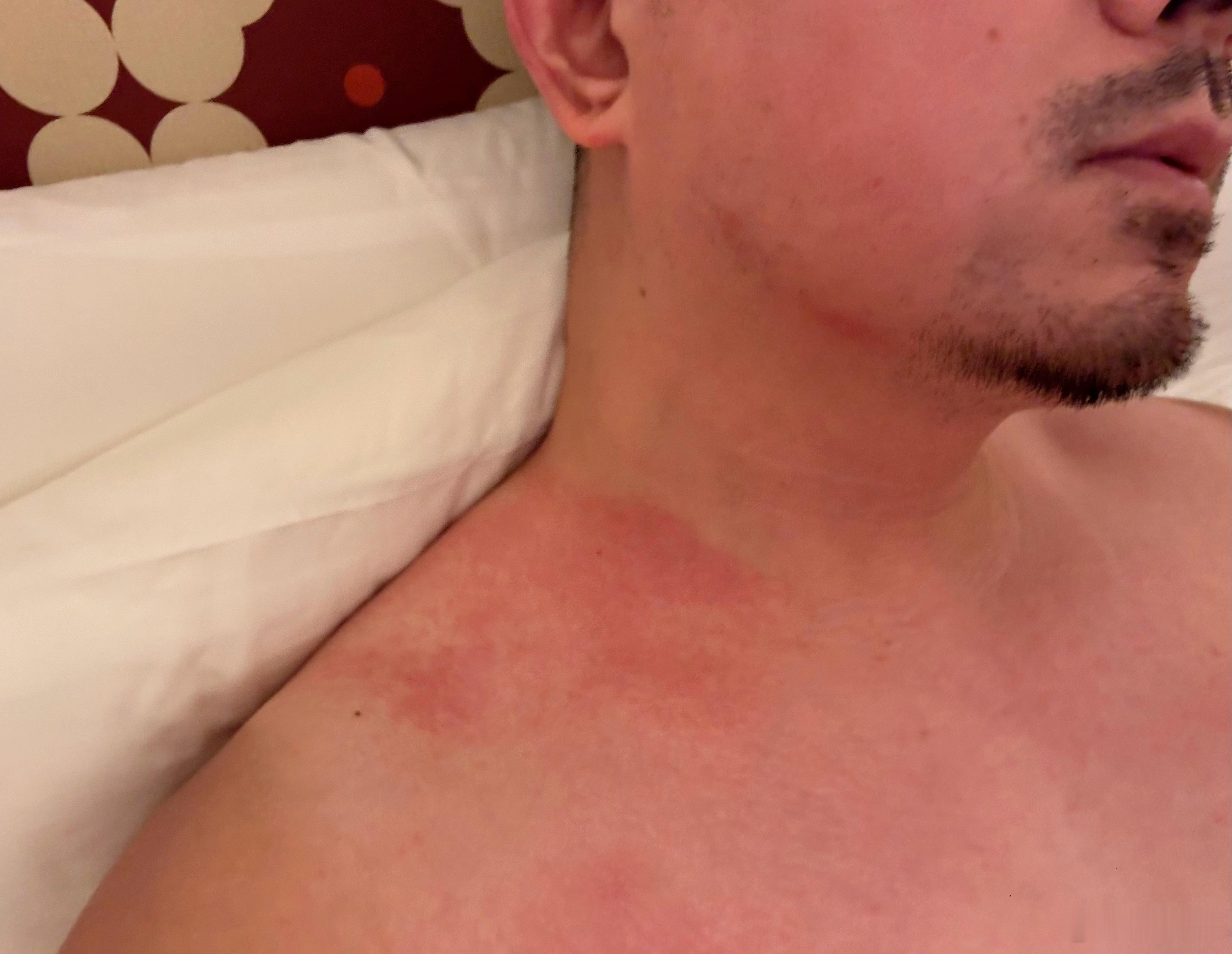 真的就没有不过敏的膏药贴么[苦涩]  ​​​